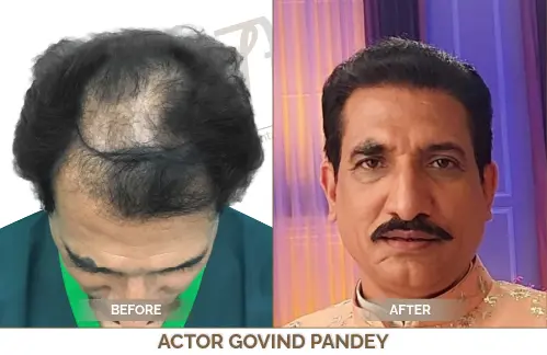 Celebrity Hair Transplant
