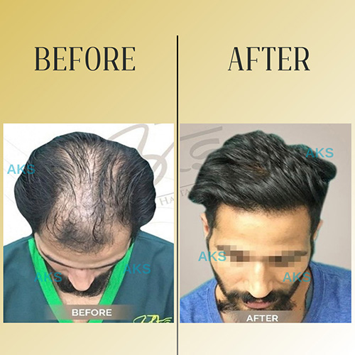 AKS clinic Before and After 10 AKS clinic Before and After 10